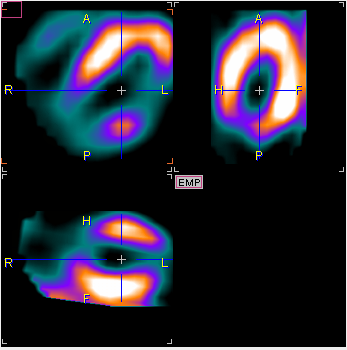 P3D SPECT matched