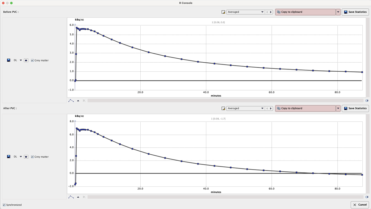 PVC_MRI_Statistics