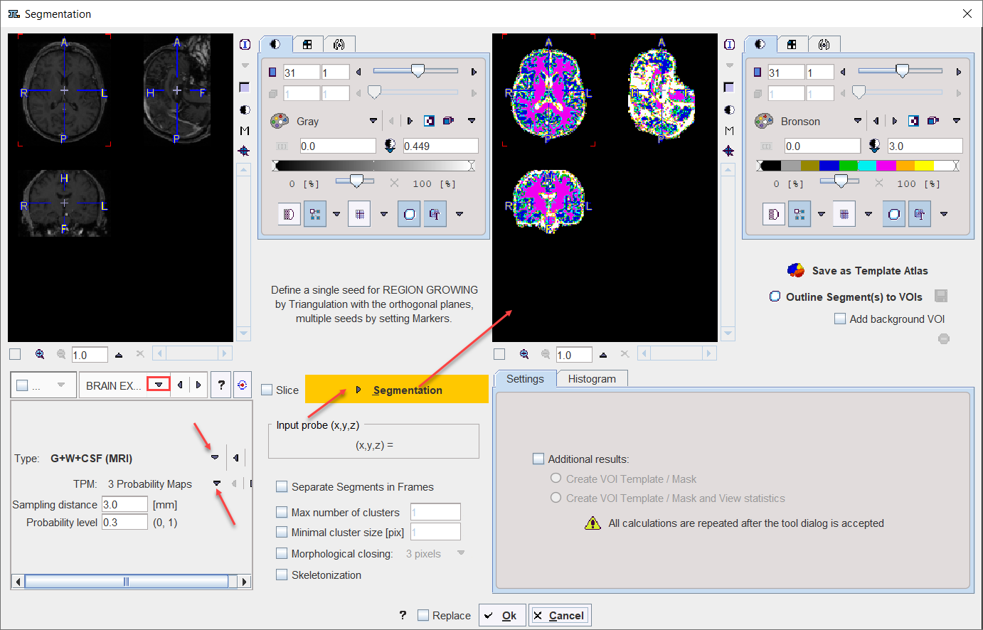 SegmentationBrainExtraction