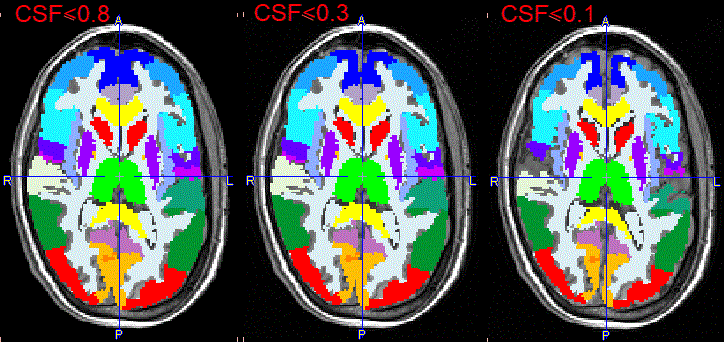 Outlining of Brain Structure (5) bis